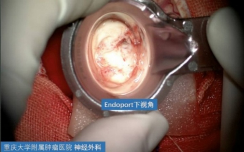 重慶大學附屬腫瘤醫院神經外科手術集錦：Endoport下腦室巨大占位性病變切除術